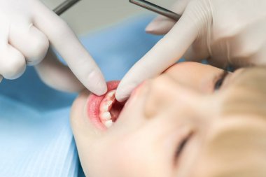 Yakın çekim dişçi el süt dişleri ve molar gösteren. Bebek diş kalıcı ile Replacemnet. Diş düştükten sonra delik. Çocuk dişleri büyüyen