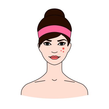 Kadının yüzü sivilce ile. Cilt sağlığı sorunları kavramı. Dermatolojik hastalıklar.