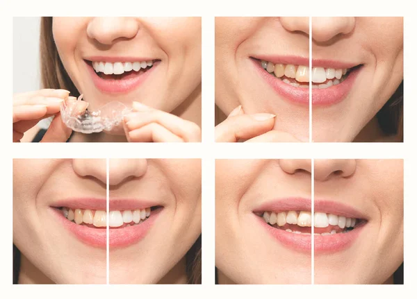 Blanqueamiento Dientes Sonreír Antes Después Blanquear Collage Salud Dental — Foto de Stock