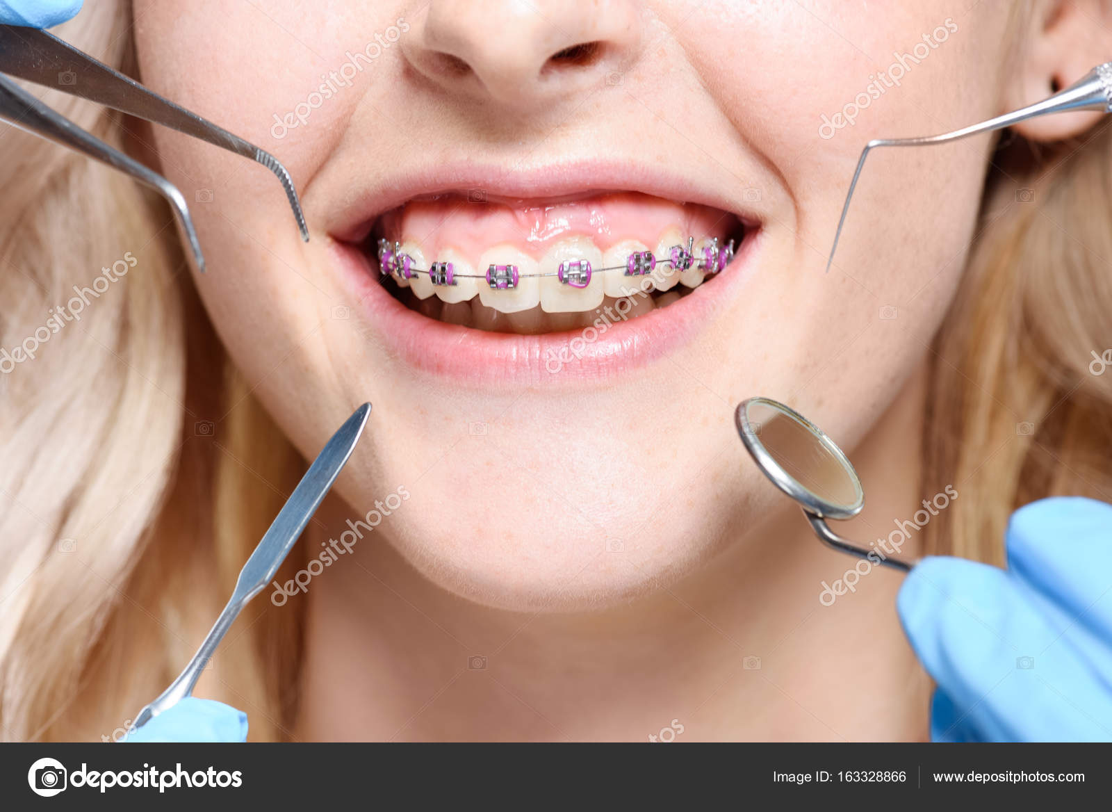 Сколько Стоит Купить И Установить Брекеты