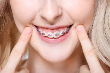 Diş diş telleri ile işaret eden kadın