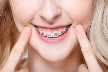 Woman pointing to teeth with braces clipart