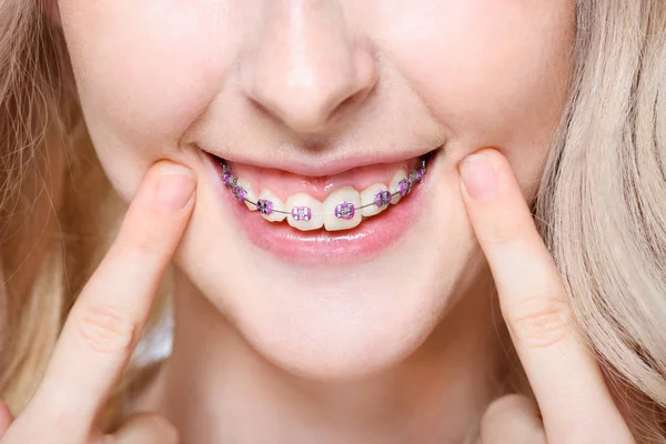 Mulher apontando para dentes com aparelho — Fotografia de Stock