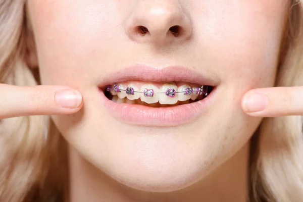 Braces — Stock Photo, Image