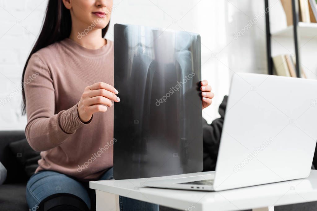 Cropped view of girl showing x-ray of leg on online consultation with doctor on laptop