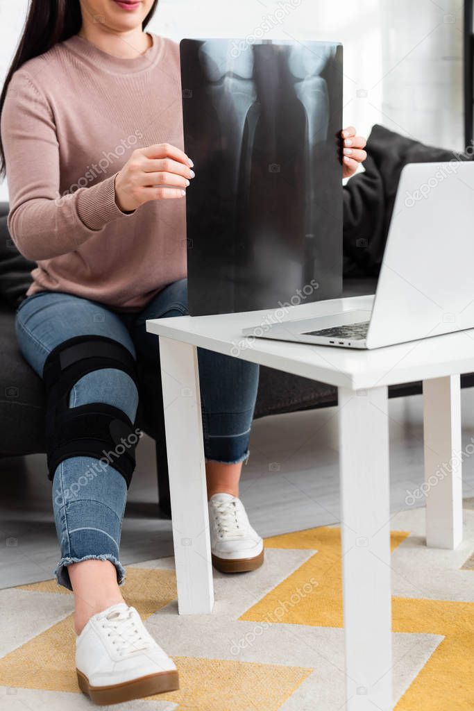 Cropped view of woman showing x-ray of leg on online consultation with doctor on laptop