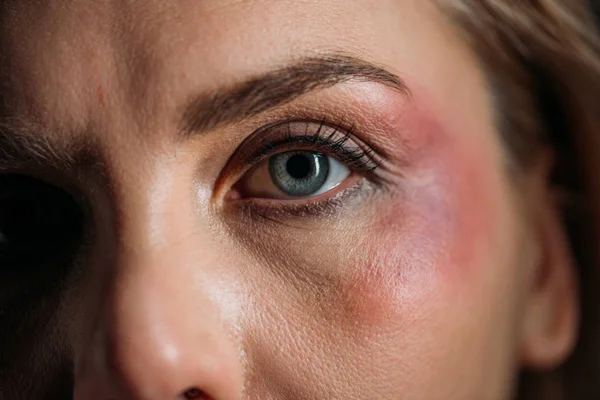Vista Cortada Rosto Vítima Com Hematomas Lado Olho — Fotografia de Stock