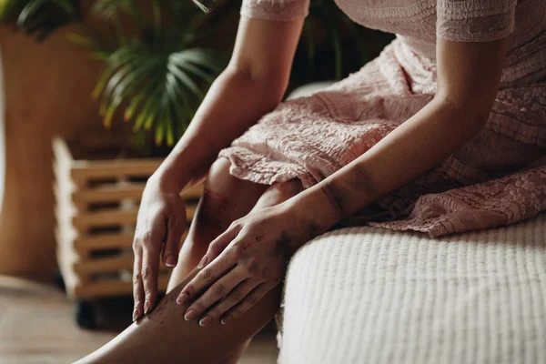 Cropped View Victim Touching Legs Lot Bruises Sitting Sofa Room — Stock Photo, Image