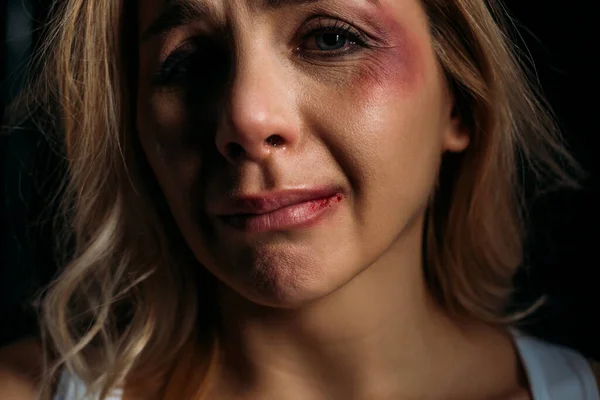 Vítima com hematomas chorando e olhando para a câmera isolada em preto — Fotografia de Stock