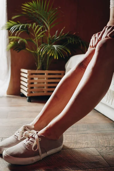 Cropped view of Victim legs wit bruises in room — Stock Photo