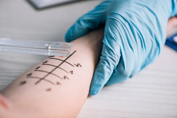 Ausgeschnittene Ansicht eines Arztes in Latex-Handschuhen beim Allergietest für Frau in Klinik — Stockfoto