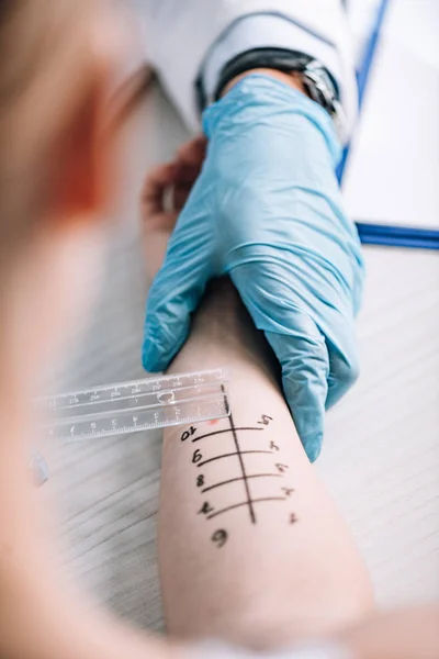 Cropped view of allergist holding ruler near marked hand of woman — Stock Photo