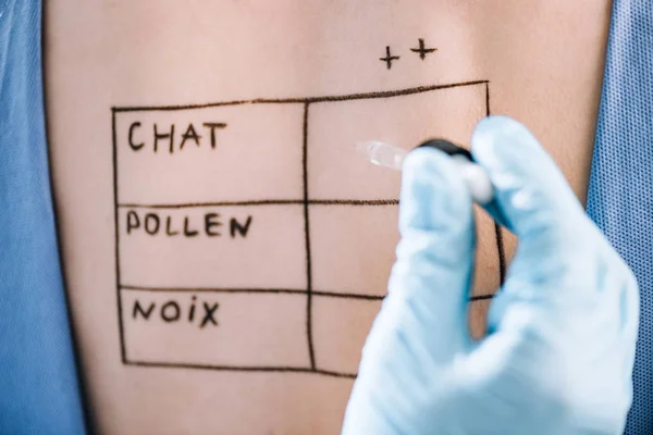 Close up of doctor holding pipette near woman with letters on marked back — Stock Photo