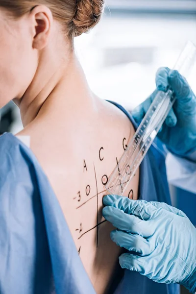 Vista ritagliata di allergologo in guanti di lattice tenendo righello vicino al paziente con schiena marcata — Foto stock