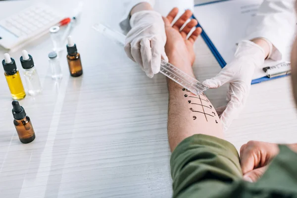 Sobrecarga de alergista segurando régua perto mão marcada sobre o homem na clínica — Fotografia de Stock