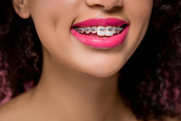 Vista cortada de menina americana africana sorridente com aparelho dental e lábios cor de rosa — Fotografia de Stock