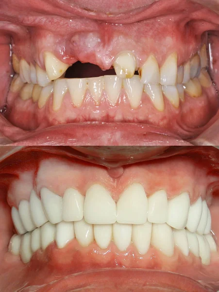 Fechar a boca de um paciente numa clínica dentária. Antes e depois — Fotografia de Stock