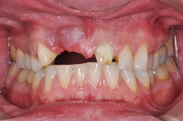 Close up da boca de um paciente sem dente na clínica odontológica — Fotografia de Stock