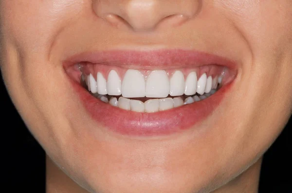 Close up of beautiful healthy white teeth smiling woman — Stock Photo, Image