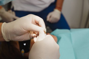 Lehçe matkap, hazırlama ve seramik diş taç yükleme işlemini kapatın. Erkek profesyonel diş hekimi diş Kliniği hafif ofis modern araçlar ekipman ile kadın hastanın tedavisinde yardımcı olur.