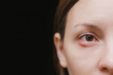Close up of young caucasian brunette woman barley brown one eye infection, eyelid abscess, stye, hordeolum. Concept of health, disease and treatment. Copy space for advertisement. With place for text. clipart