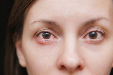 Close up photo of young caucasian brunette woman barley brown eye infection, eyelid abscess, stye, hordeolum. Concept of health, disease and treatment. clipart