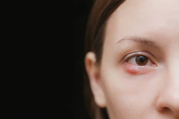 Close up de jovem mulher morena caucasiana cevada marrom uma infecção ocular, abscesso palpebral, stye, hordeolum. Conceito de saúde, doença e tratamento. Espaço de cópia para propaganda. Com lugar para texto . — Fotografia de Stock