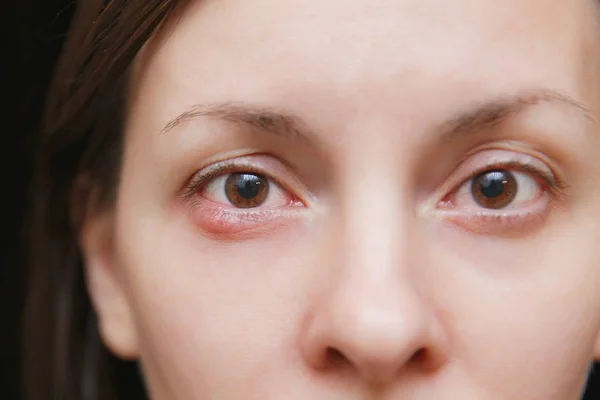 De cerca foto de joven caucásico morena mujer cebada marrón infección ocular, absceso del párpado, orzuelo, hordeolum. Concepto de salud, enfermedad y tratamiento . — Foto de Stock