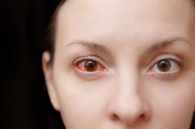 Close up of one annoyed red blood and health eye of female affected by conjunctivitis or after flu, cold or allergy. Concept of disease and treatment. Copy space for advertisement. With place for text clipart