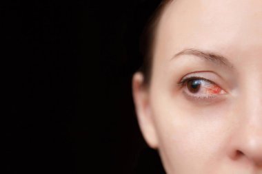 Close up of one annoyed red blood eye of female affected by conjunctivitis or after flu, cold or allergy. Concept of health, disease and treatment. Copy space for advertisement. With place for text. clipart