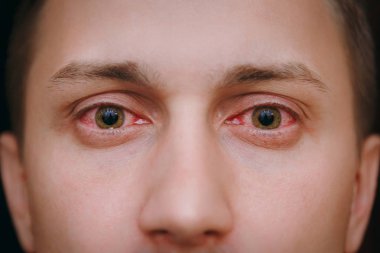 Close up of two annoyed red blood eyes of a man affected by conjunctivitis clipart