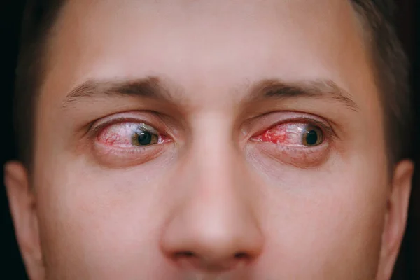 Konjonktivit tarafından etkilenen bir adamın iki rahatsız kırmızı kan göz yakın çekim — Stok fotoğraf