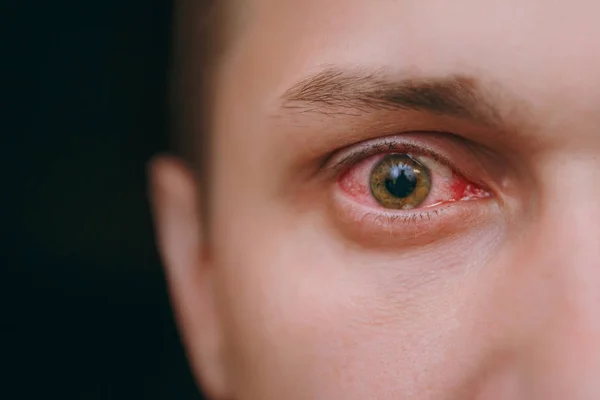 Close up of one annoyed red blood eye of a man affected by conjunctivitis — Stock Photo, Image