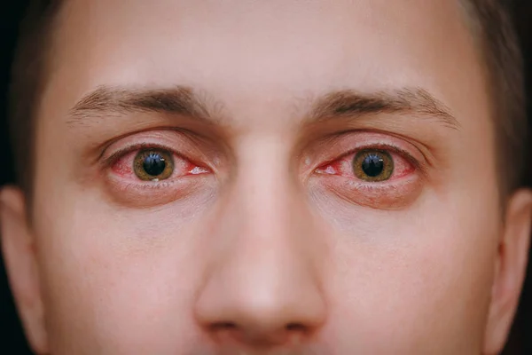 Крупный план двух раздраженных красных глаз человека, страдающего конъюнктивитом — стоковое фото