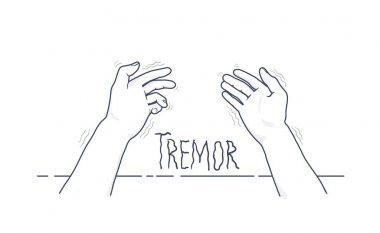 Tremor hands. First-person view of shaking hands. Symptom of Parkinsons disease. Medical vector illustration isolated on white background. clipart