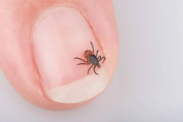 Close-up of tick on human nail. Ixodes ricinus