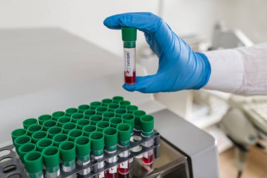 Mavi koruyucu eldiven, SARS-CoV-2 test tüpü tutuyor. Bulaşıcı COVID-19. Otomatik analiz cihazı ve kan örnekleri olan bir laboratuvar. Virüs enfeksiyonunun pozitif sonucu. Koronavirüs salgını.