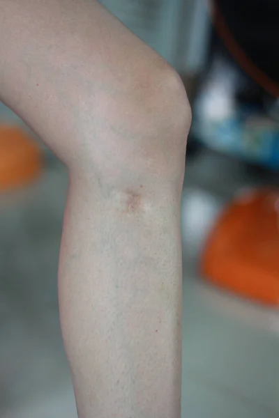 腿周围皮肤上有刀疤 女孩腿上有刀疤 腿上的伤引起的静脉曲张 — 图库照片