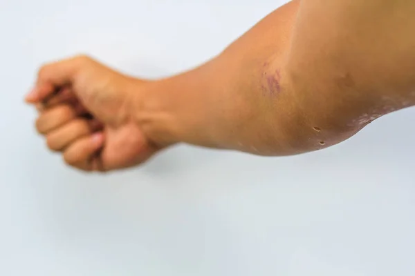 Bruises Blood Collection Purple Bruise Arm Serective Focus — Stock Photo, Image