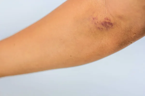 Moretones Por Recolección Sangre Moretón Morado Brazo Enfoque Sertivo —  Fotos de Stock