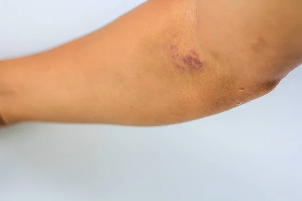 Hematomas Recolha Sangue Contusão Roxa Braço Foco Serectivo — Fotografia de Stock