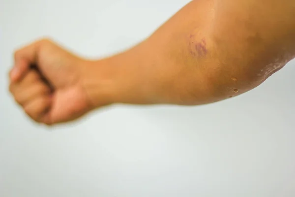 采血时的瘀伤手臂上的紫色瘀伤 确定重点 — 图库照片