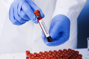 Coronavirus 2019-ncov kan örneği. Corona virüsü salgını. Salgın Virüsü Solunum Sendromu