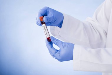 Coronavirus 2019-ncov kan örneği. Corona virüsü salgını. Salgın Virüsü Solunum Sendromu