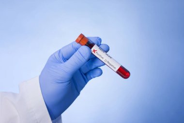 Coronavirus 2019-ncov kan örneği. Corona virüsü salgını. Salgın Virüsü Solunum Sendromu