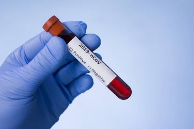 Coronavirus kan testi sonucu vakum test tüpündeki koronavirüs enfeksiyonu laboratuvarda Coronavirus metniyle doktorların ellerinde. Tanı, tespit, Çin koronavirüsü analizi. Salgın