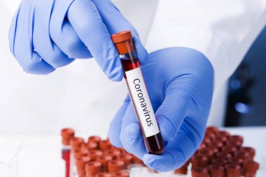 Coronavirus kan testi sonucu vakum test tüpündeki koronavirüs enfeksiyonu laboratuvarda Coronavirus metniyle doktorların ellerinde. Tanı, tespit, Çin koronavirüsü analizi. Salgın