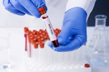 Coronavirus kan testi sonucu vakum test tüpündeki koronavirüs enfeksiyonu laboratuardaki Coronavirus metniyle doktorların ellerinde..