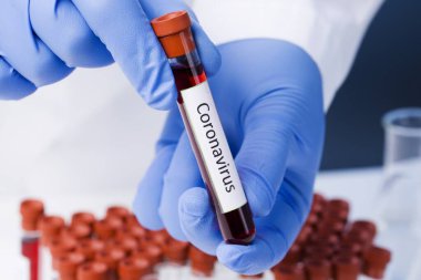 Coronavirus kan testi sonucu vakum test tüpündeki koronavirüs enfeksiyonu laboratuardaki Coronavirus metniyle doktorların ellerinde..