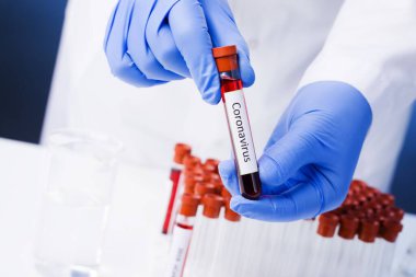 Yeni hızla yayılan Coronavirus, Coronavirus 2019-nCoV kan örneği için pozitif kan testi sonucu. Corona virüsü salgını. Salgın Virüsü Solunum Sendromu.
